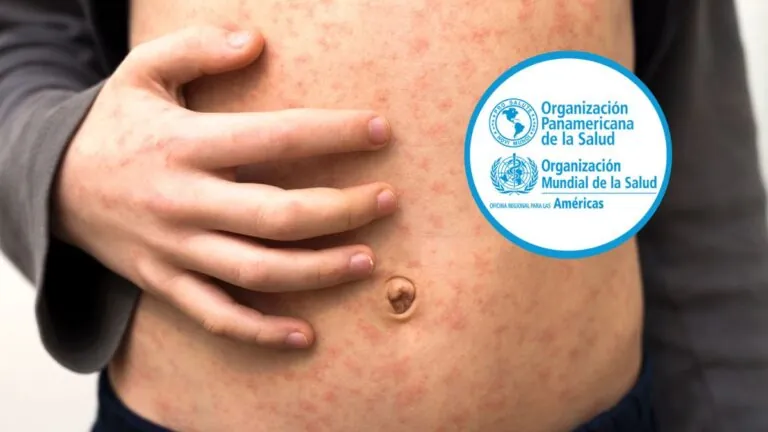 Brotes de sarampión en 10 países de las Américas: OPS advierte riesgo regional por baja cobertura de vacunación