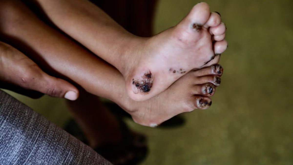 OPS lanza las primeras directrices mundiales basadas en evidencia para el tratamiento de la tungiasis