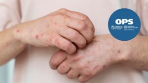 Colombia mantiene estatus libre de Sarampión y Rubéola tras verificación de la OPS/OMS