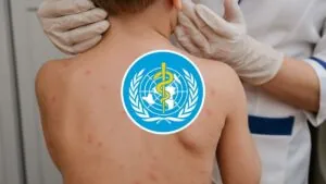 Eliminación del sarampión en riesgo: OMS alerta aumento de brotes y brechas de inmunidad en 2024