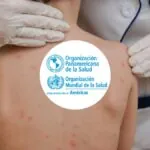 OPS alerta sobre la pérdida del estatus de eliminación del sarampión en las Américas y pide reforzar la vacunación