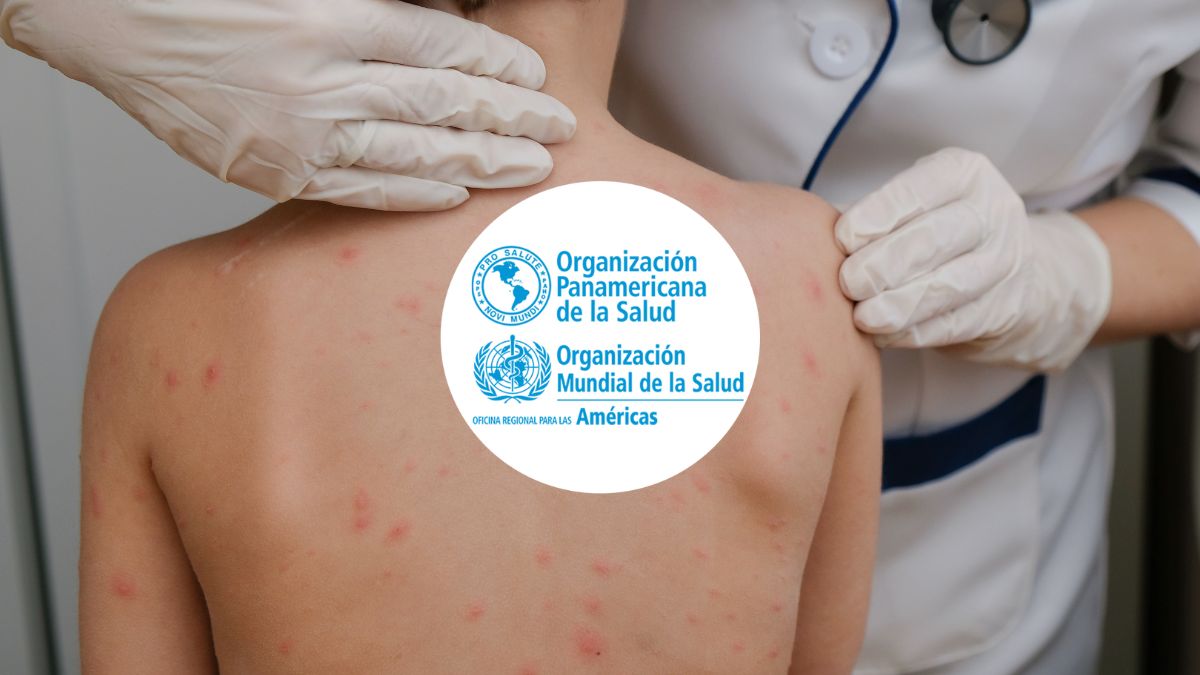 OPS alerta sobre la pérdida del estatus de eliminación del sarampión en las Américas y pide reforzar la vacunación