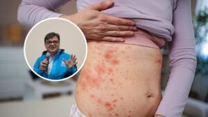 Se detecta en Bogotá caso importado de sarampión, se mantiene en vigilancia activa y sin evidencia de transmisión local