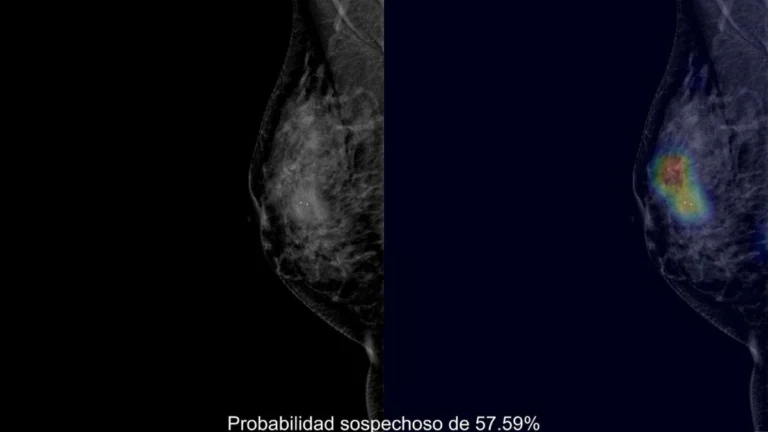 Hospital del Mar desarrolla una IA para apoyar la interpretación de mamografías y recibe doble reconocimiento