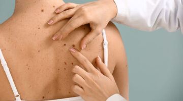 7.401 personas han sido diagnosticadas con melanoma Cuenta de Alto Costo