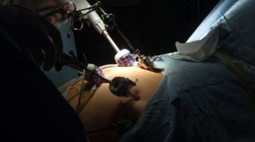 Corte constitucional ordena a EPS autorizar cirugías de Bypass a pacientes con obesidad mórbida