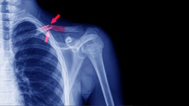 ARNm prometedor para la regeneración de huesos