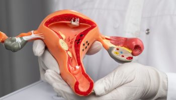 Acceso a Olaparib en pacientes con cáncer de ovario seroso en Colombia