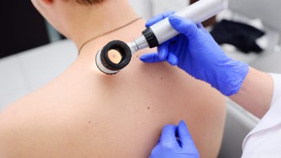 Antibióticos podrían ayudar a tratar los melanomas