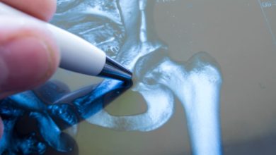 Artrosis identifican nuevos factores de riesgo genético