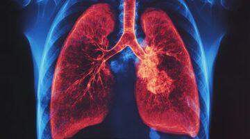 AstraZeneca apuesta por la detección temprana del cáncer de pulmón con la Plataforma Salvando Vidas