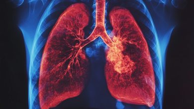 AstraZeneca apuesta por la detección temprana del cáncer de pulmón con la Plataforma Salvando Vidas