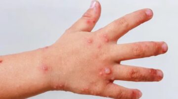 Autoridades de salud en Cartagena activan alerta por brote viral en población infantil