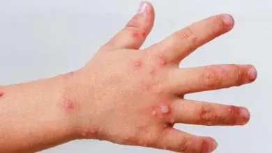 Autoridades de salud en Cartagena activan alerta por brote viral en población infantil