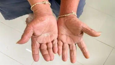 Avances y Tratamiento de la Esclerodermia: tomando conciencia sobre una Enfermedad Crónica del Tejido Conectivo