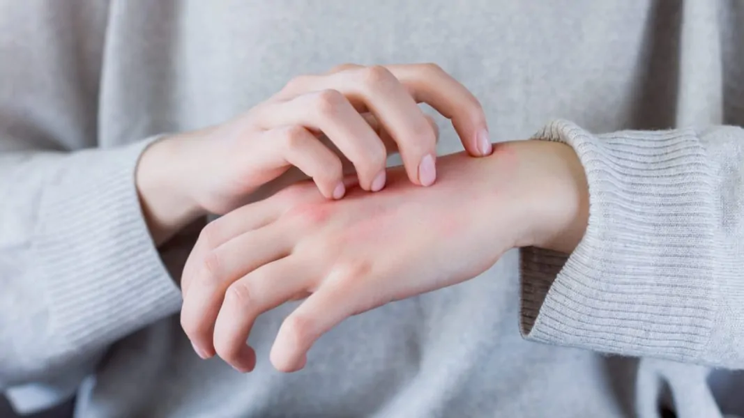 BIGDATA DERMATITIS ATÓPICA