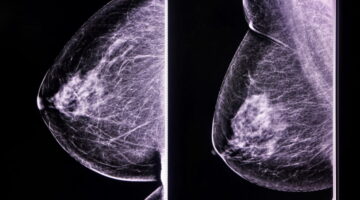 Banco de tumores facilita creación de terapias personalizadas en cáncer de mama