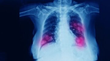 Bases de la herramienta técnica para cáncer de pulmón, diseñada por la CAC