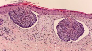 Bavencio de Merck muestra buenos resultados en ensayos de fase 3 para carcinoma urotelial