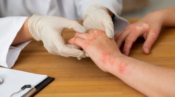 Bogotá sede del Foro IFPA : un encuentro histórico sobre la psoriasis en América Latina