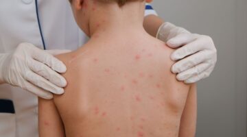 Brote de sarampión en Texas crece a 124 casos y genera alerta por posible expansión