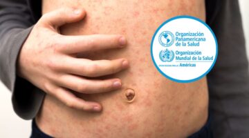 Brotes de sarampión en 10 países de las Américas: OPS advierte riesgo regional por baja cobertura de vacunación