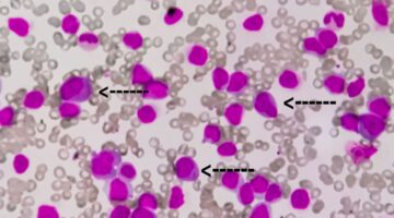 CAC lanzó herramienta técnica para mieloma múltiple