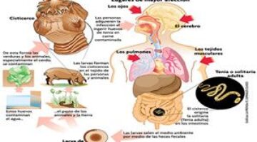 ¿Qué es la Cisticercosis?