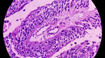 Cambios en la guía clínica para el manejo del cáncer del tracto urinario