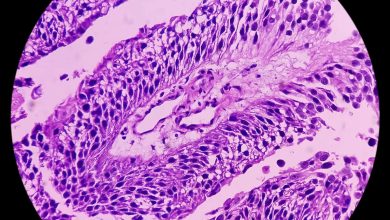 Cambios en la guía clínica para el manejo del cáncer del tracto urinario