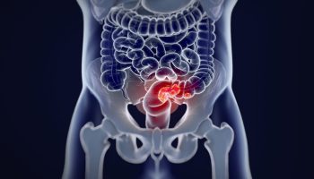 Cáncer de colón y recto ¿cómo está su situación en Colombia