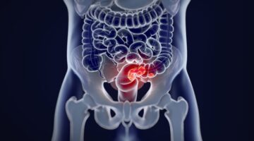 Cáncer de colón y recto ¿cómo está su situación en Colombia