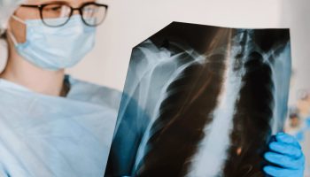 Cancer en los pulmones