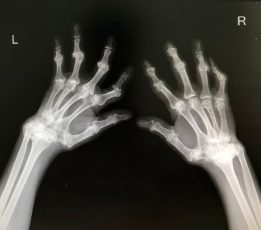 Carga mundial de la artritis reumatoide: desafíos y proyecciones hasta 2050