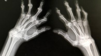 Carga mundial de la artritis reumatoide: desafíos y proyecciones hasta 2050