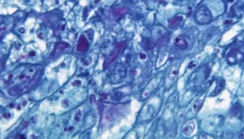 Casos de viruela símica crecieron el 20% en el mundo