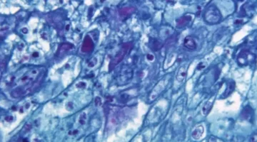 Casos de viruela símica crecieron el 20% en el mundo