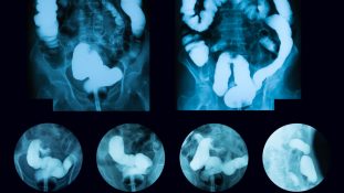 Científicos usan Inteligencia artificial para diagnosticar y tratar el cáncer de colon