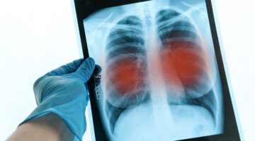 Colombia cuarto país de América con más casos de tuberculosis resistente