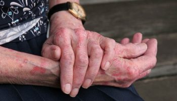 Colombia erradica la lepra menos de 1 caso por 10.000 habitantes