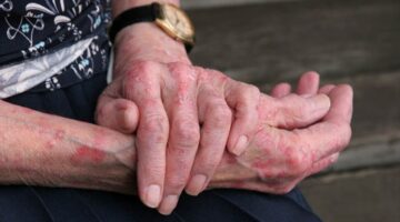 Colombia erradica la lepra menos de 1 caso por 10.000 habitantes