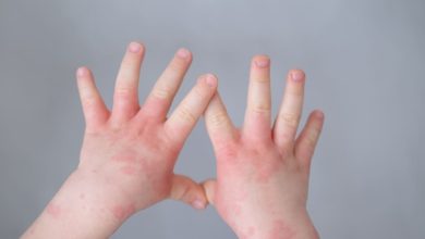 Comisión Europea aprobó tratamiento para dermatitis atópica en niños