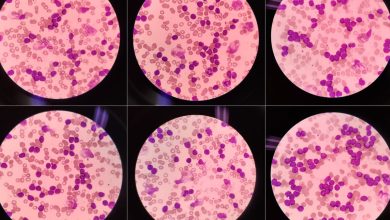 Conozca las Guías de Práctica Clínica para la leucemia linfocítica crónica