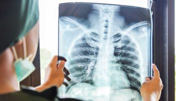 Contaminación del aire puede desencadenar cáncer de pulmón en no fumadores