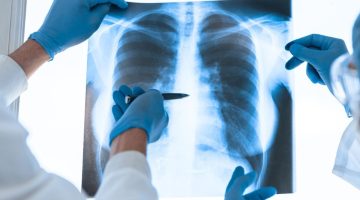 Costo-efectividad del cáncer de pulmón en Colombia: impacto clínico y económico del diagnóstico y el tratamiento