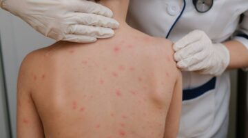 Crisis de sarampión en Europa, OMS y UNICEF alertan sobre el peor brote en 25 años