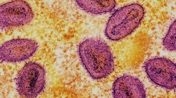 Cundinamarca sin riesgo de Mpox, refuerza medidas preventivas