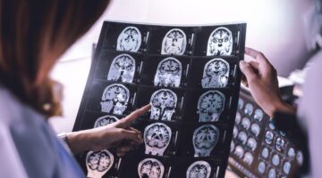 40% casos de demencia son evitables