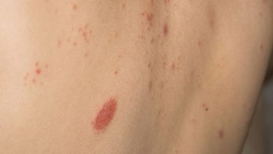 Dermatitis atopica, mas que una alergia en la piel