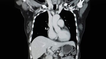 Desarrollan resonancia magnética que analiza el corazón en menos de 1 minuto